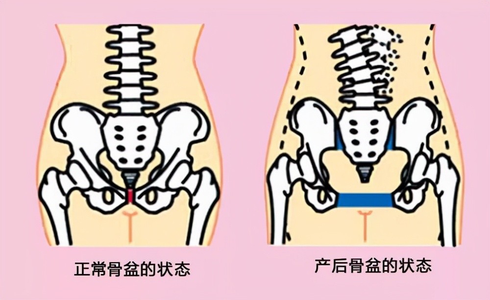 一篇干货让你看懂骨盆修复建议马克