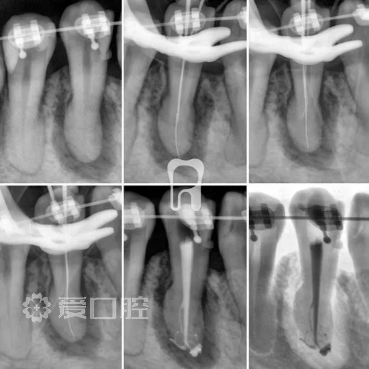 44 牙根增粗膨大rct根充x片前后1例