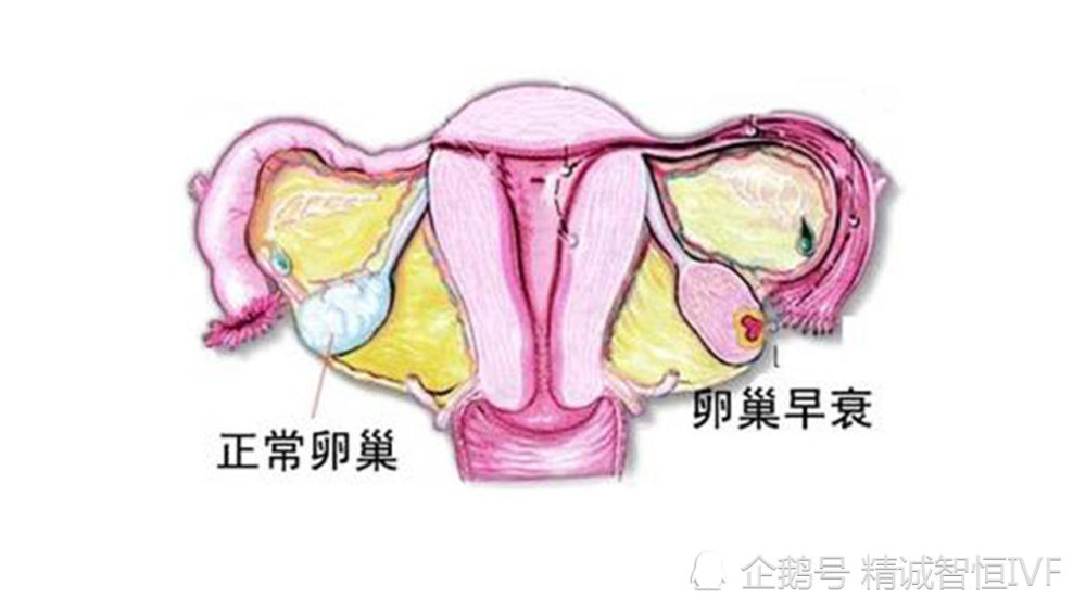 卵巢早衰示意图