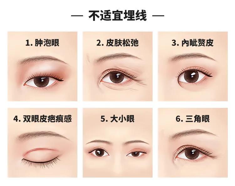割的双眼皮怎么才能看不出来