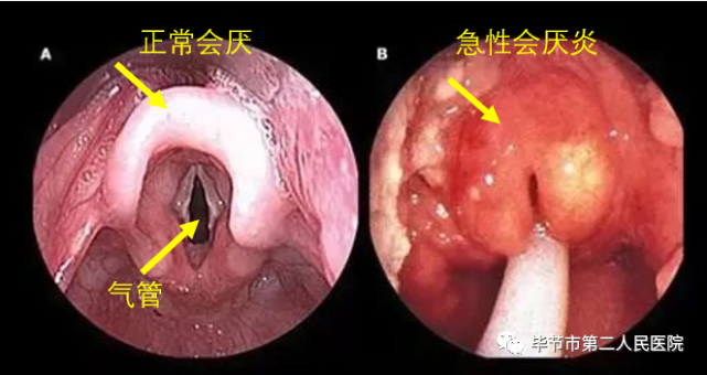 急性会厌炎了解下!