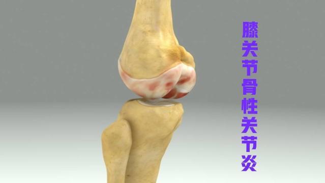 骨性关节炎是怎么回事|骨关节炎|膝关节|关节软骨