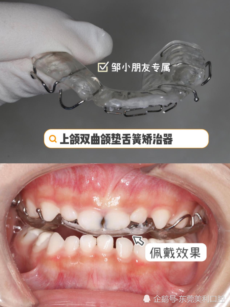 东莞美利口腔:儿童矫治,早期干预效果好