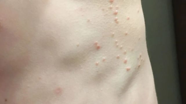 contagiosum)传染性软疣:好发于儿童,典型表现是脐凹状丘疹,表面有