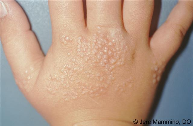 org/page/lichennitidus)光泽苔藓:是一种较少见的慢性皮肤病,多见于