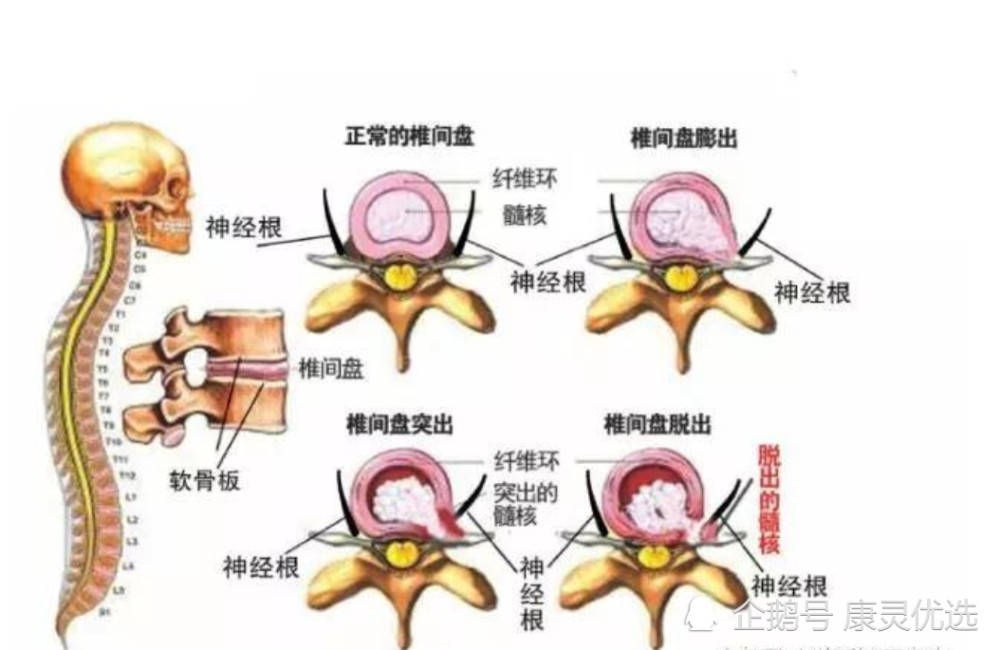 腰椎间盘突出按轻中重度分为3个等级,你的腰突疼痛处于哪一个阶段?