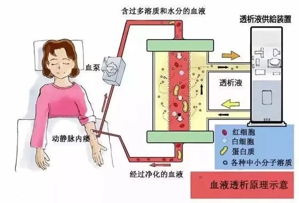 血液透析:适应症