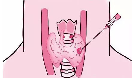 甲状腺结节微波消融治疗