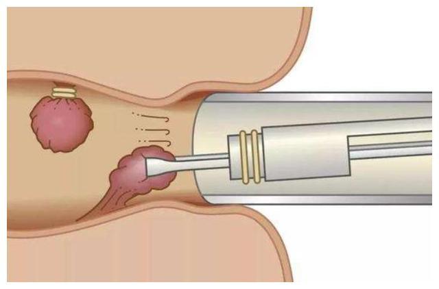 肛门附近长出"小肉球",别只以为是痔疮,也可能是这2种