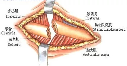 一文掌握|锁骨骨折的固定及手术技巧都在这了!