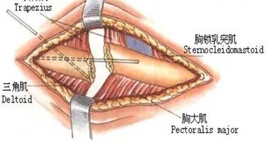 用挡板或骨膜剥离器保护好锁骨下血管,神经及胸膜顶.
