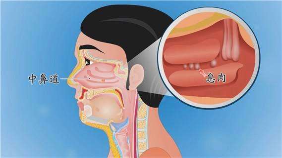 南大学崇爱医院耳鼻喉专科医师讲解鼻窦炎的症状