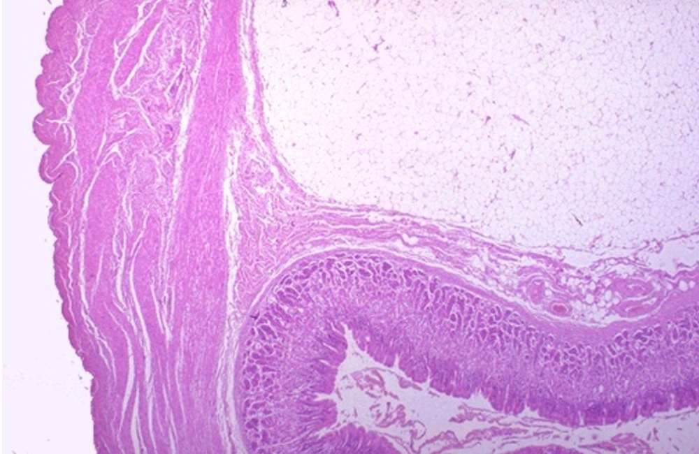 良性肿瘤的特征-小肠浆膜表面的良性脂肪瘤