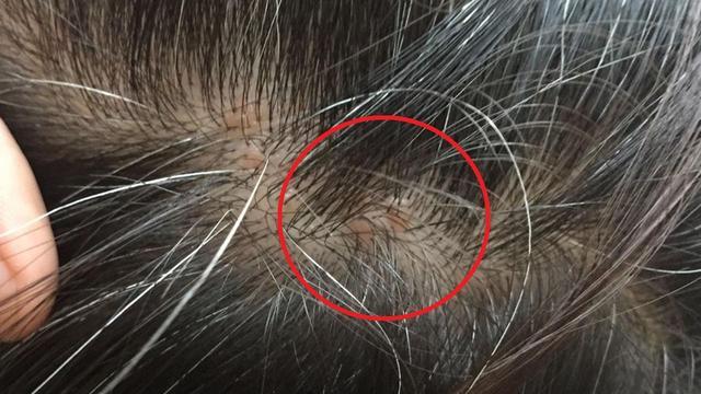 为什么头皮与后背总爱"长疙瘩"?可能和4个原因有关,要注意