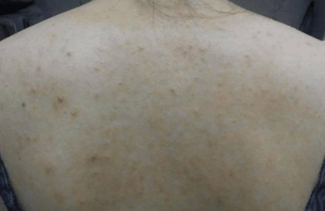 为什么头皮与后背总爱"长疙瘩"?可能和4个原因有关,要