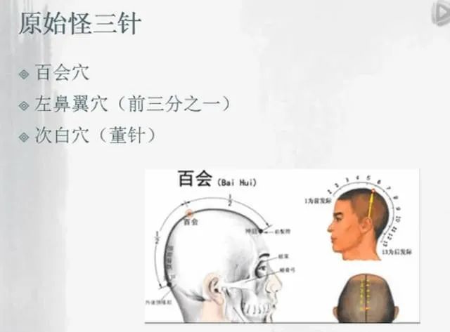 胡光医师怪三针精讲应用