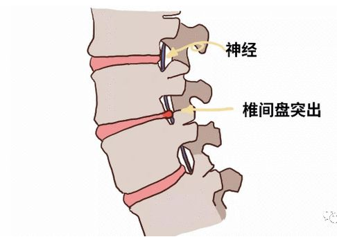 北京天使望京妇儿医院中医尹彬主任双桥正骨如何调治腰椎间盘突出