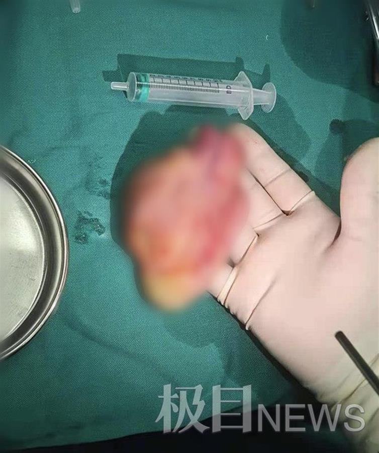 12cm!罕见巨大鼻息肉竟从鼻子卡入喉咙,医生另辟蹊径帮助老人脱险