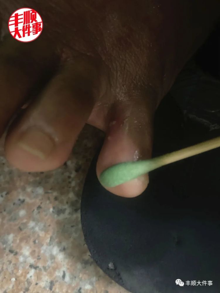 丰顺一女子散步被蚂蚁咬伤后,眼睛看不见,上吐下泻,呼吸困难,差点休克