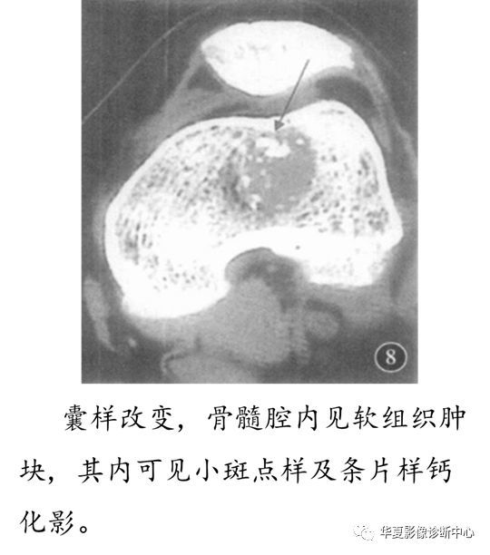 长骨内生软骨瘤