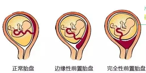 凶险性前置胎盘产妇涉险生三胎风暴过后母子平安子宫保全