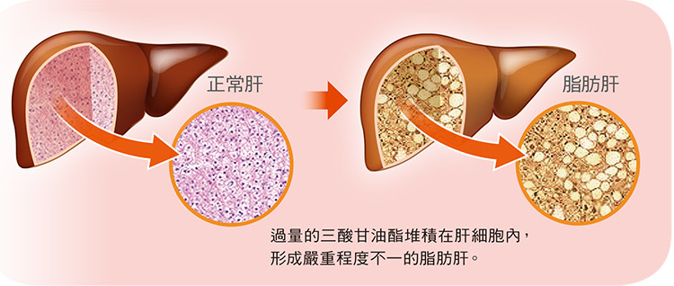 脂肪肝是怎么形成的?有特效药改善吗?三步骤来消脂,保肝,减重