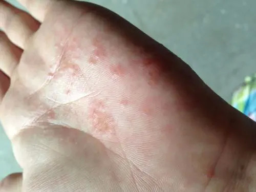 长春肤康医院浅谈:皮炎与湿疹之间到底有哪些区别?