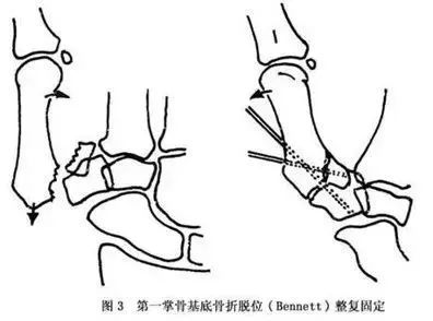 精华|第一掌骨基底部骨折,详细手术要点都在这!