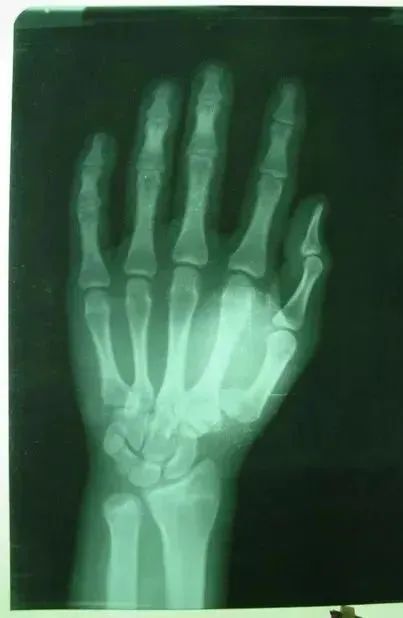 3,骨块较小不易固定时-第一掌骨固定于大多角骨或第二掌骨上-或用两