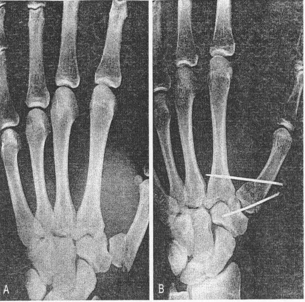 固定于大多角骨上;2,内侧有较大骨折块时-将其直接固定在第一掌骨上;1