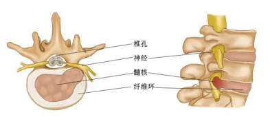 连同髓核,软骨终版向外突出,刺激或压迫窦椎神经和神经根引起的以腰腿