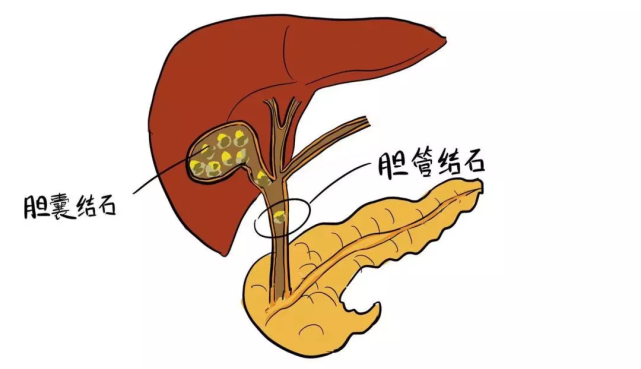 胆囊塞满结石,他不得不这样做