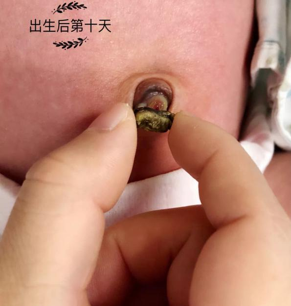 形成脐带残端,如果护理不当,脐部会出现肉芽肿,渗血,发炎
