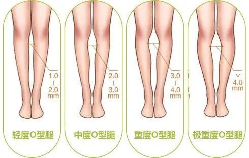 拿什么拯救你我难看的罗圈腿
