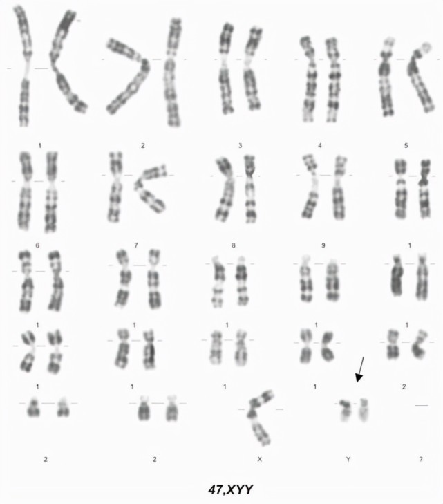 其中典型的就是在性染色体上下文章的,包括47条的xyy和xxy案例,以及45