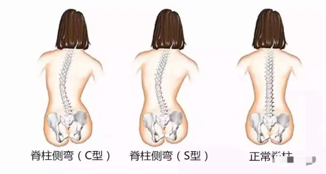 形成带有弧度的c形或s形的脊柱畸形,如图:而且女孩比男孩明显要高