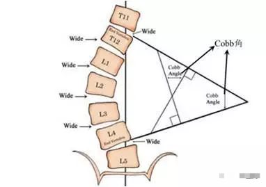 下图cobb角是衡量脊柱侧弯的标准,cobb角大于10度就可以诊断脊柱侧弯