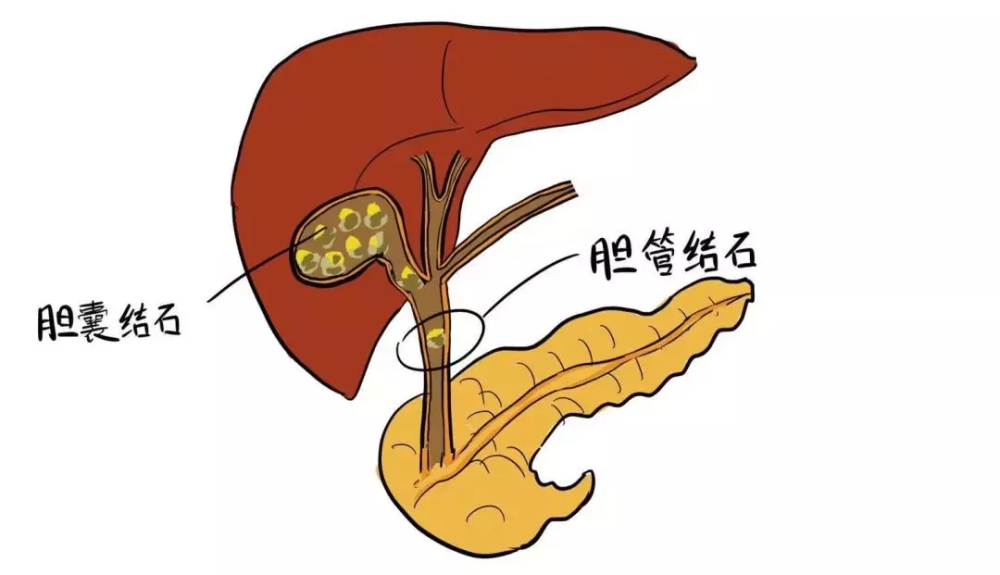 如何预防胆囊结石?看完这篇文章你就明白了