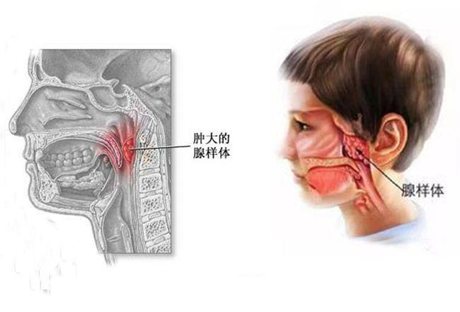 暨南大学崇爱医院耳鼻喉专科唐佰才医师讲解儿童腺样体肥大的危害