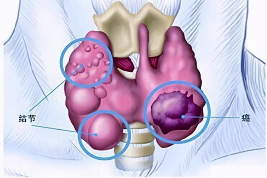 甲状腺癌被称作"好癌,发现了还要不要做手术?