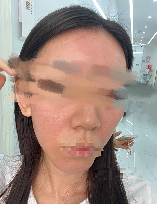 南宁小姐姐在医美机构做"赠送项目"时被灼伤,律师出面