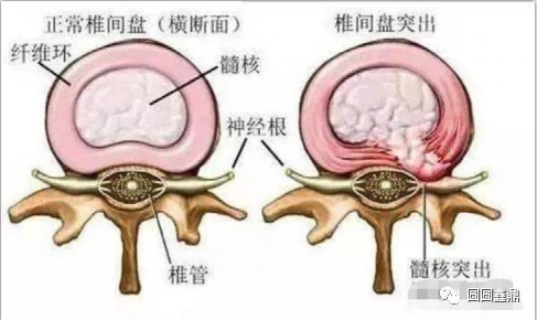 腰突了,最好的医生是自己,学会腰椎伸筋操,腰疼腿麻的