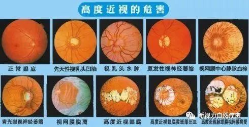 高度近视引起的并发症,要引起我们的重视了!