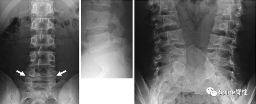 图:l4全椎板裂 16岁男孩,3年严重腰痛,后伸受限 其中l5椎体骶化 3.