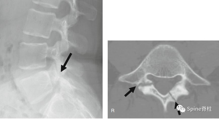 17岁腰痛男孩,l5双侧峡部裂和右侧椎板裂 c:右侧椎板增厚,不连续