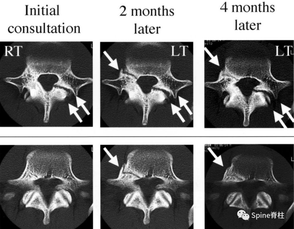 图:起始ct提示l5左侧峡部裂(双箭头,起始ct检查后2个月复查可见出现