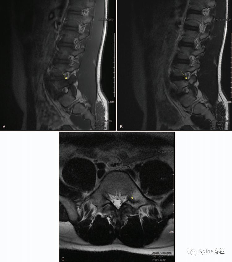 图:15岁腰痛男孩,左侧腰5椎弓根裂 a:t1左侧腰5椎弓根低信号(箭头);b