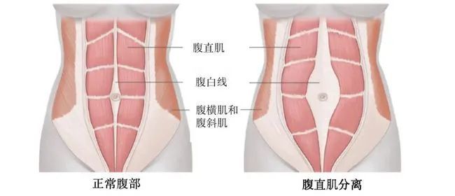 要注意的是:腹直肌可能在不同的位置出现分离(常见于肚脐周围,我们