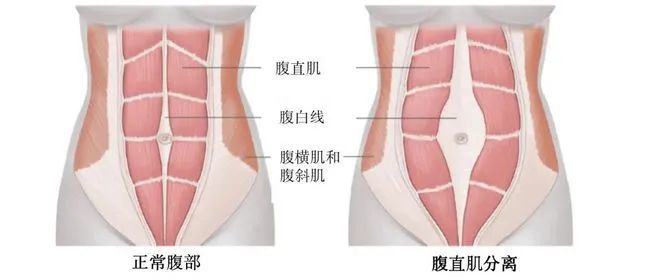 腹直肌分离康复方法:1,腹式呼吸用鼻子吸气,用嘴呼气.