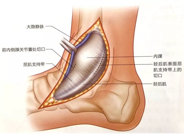 切口:在内踝近端约5cm水平,以内踝尖为中心,沿胫前内侧面做长约10cm的